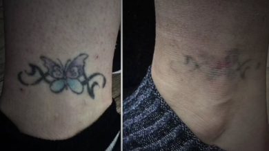 Everything You Need to Know About Laser Tattoo Removal in Pakistan