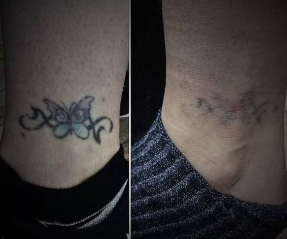 Everything You Need to Know About Laser Tattoo Removal in Pakistan