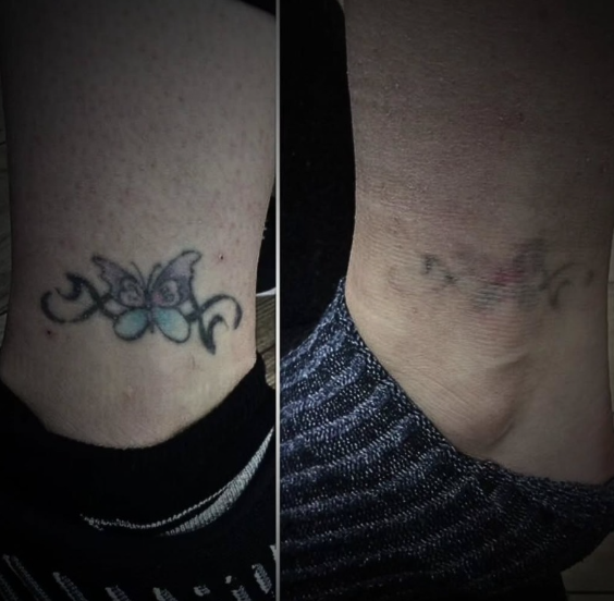 Everything You Need to Know About Laser Tattoo Removal in Pakistan